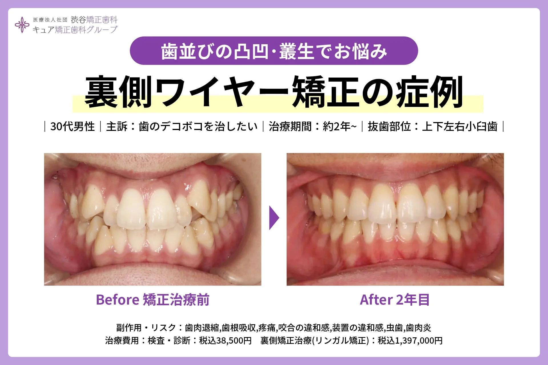 歯の凸凹（叢生）治療の症例