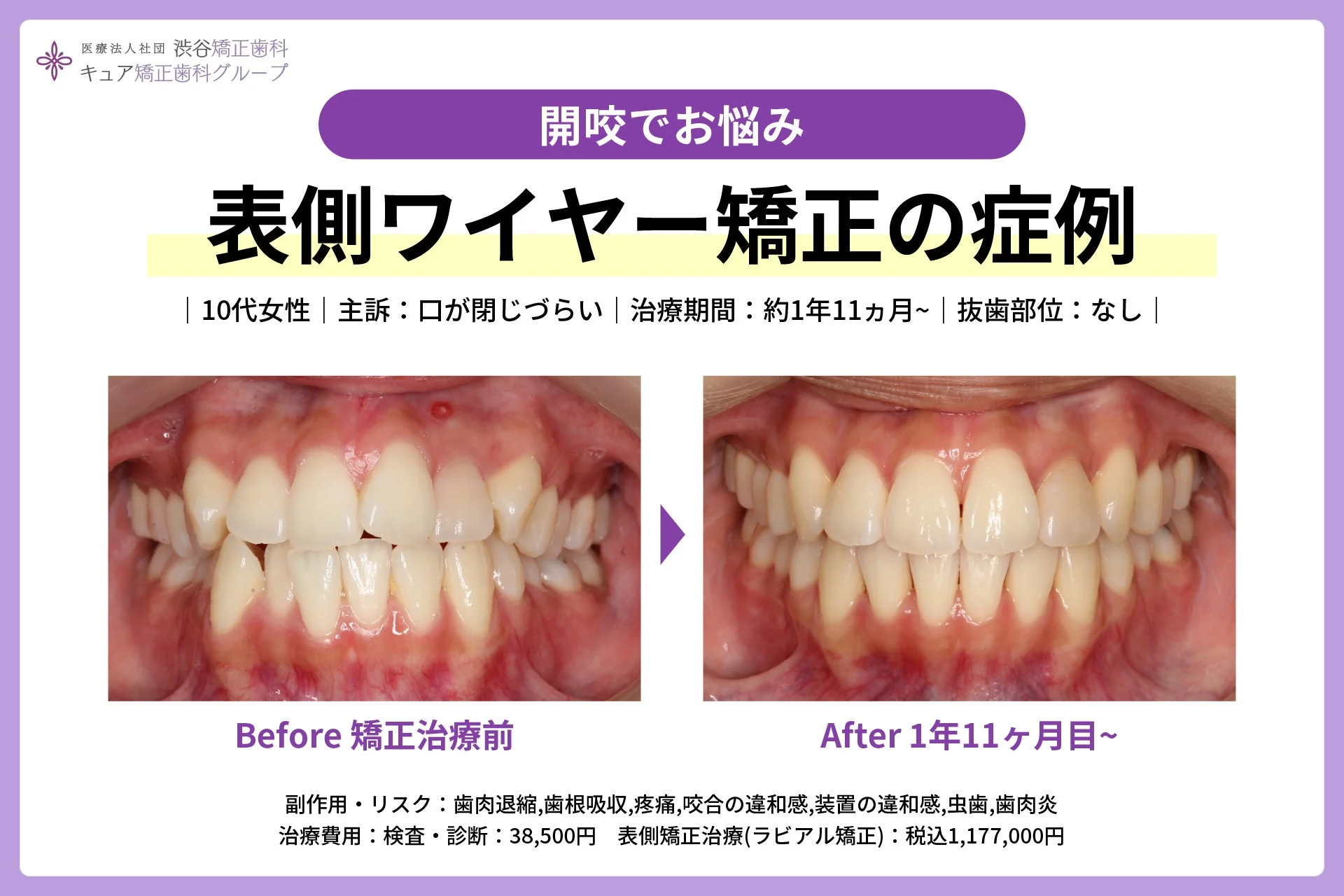 開咬治療の症例