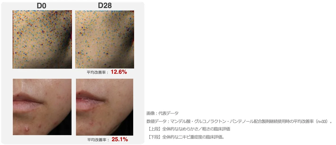 マンデル酸、グルコノラクトン、パンテノール配合製剤使用による肌のなめらかさ・ニキビ重症度の改善例