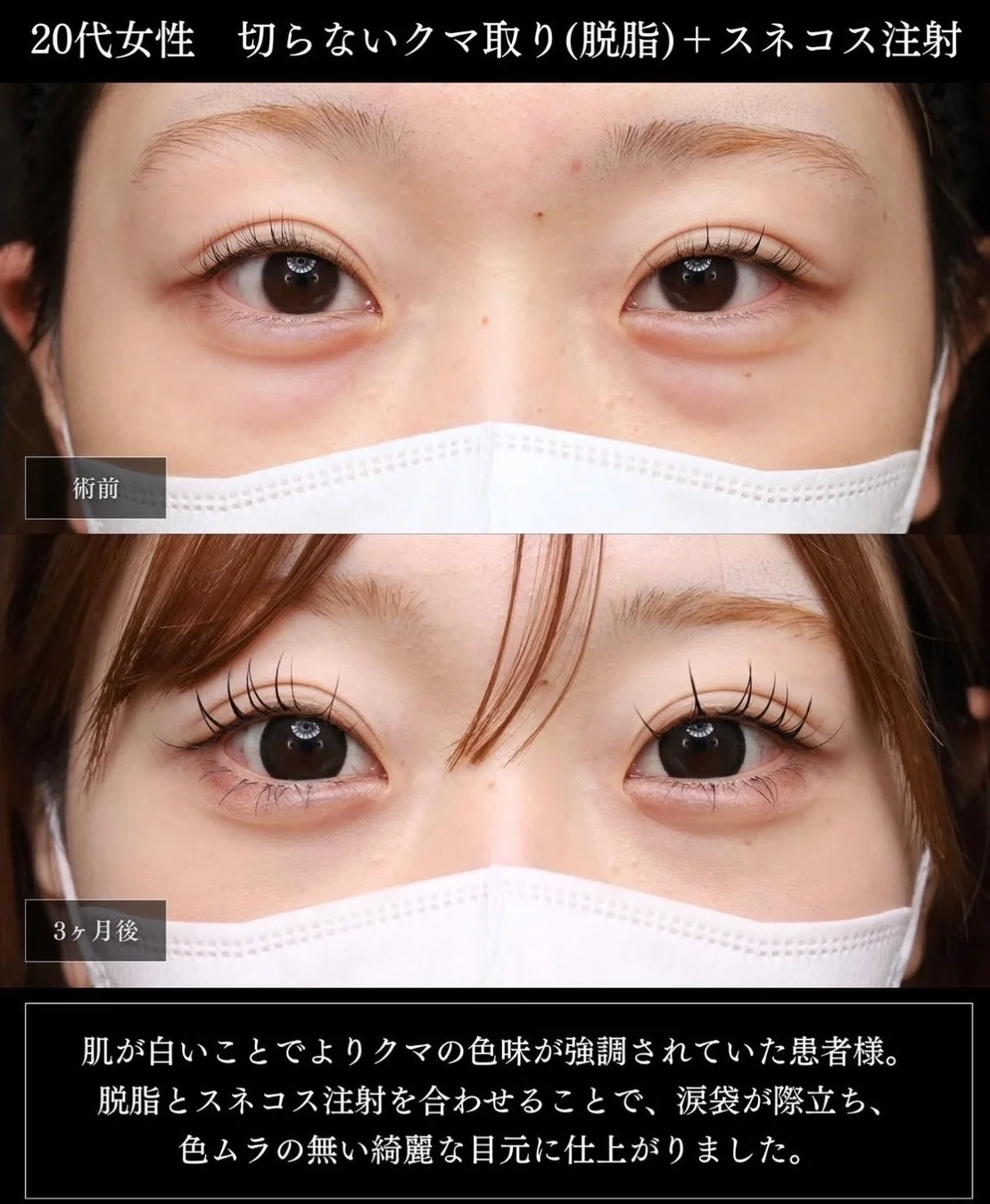 20代女性の切らないクマ取り（脱脂）＋スネコス注射の術前と3ヶ月後の比較