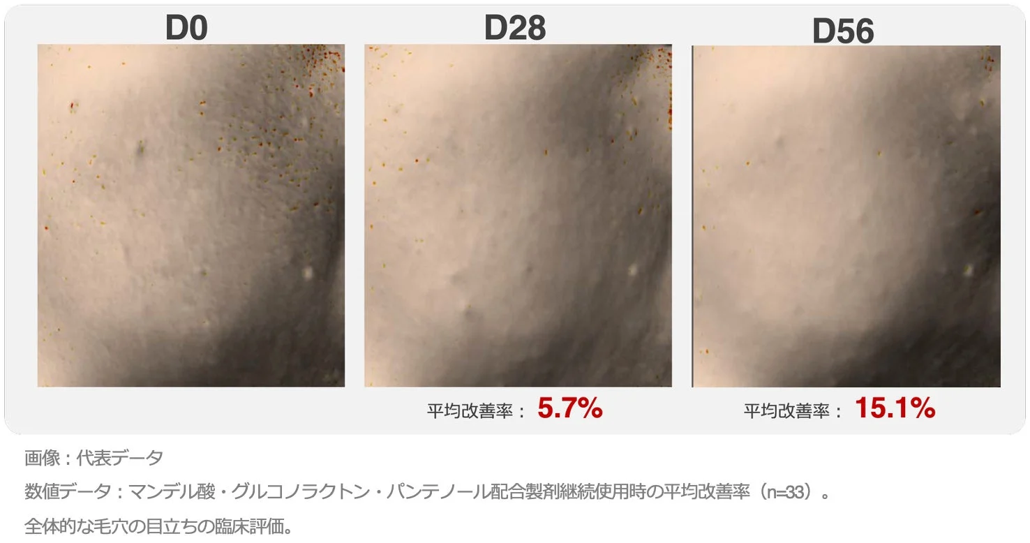 マンデル酸、グルコノラクトン、パンテノール配合製剤使用による毛穴の目立ち改善例