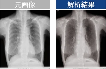 胸部X線解析結果の比較