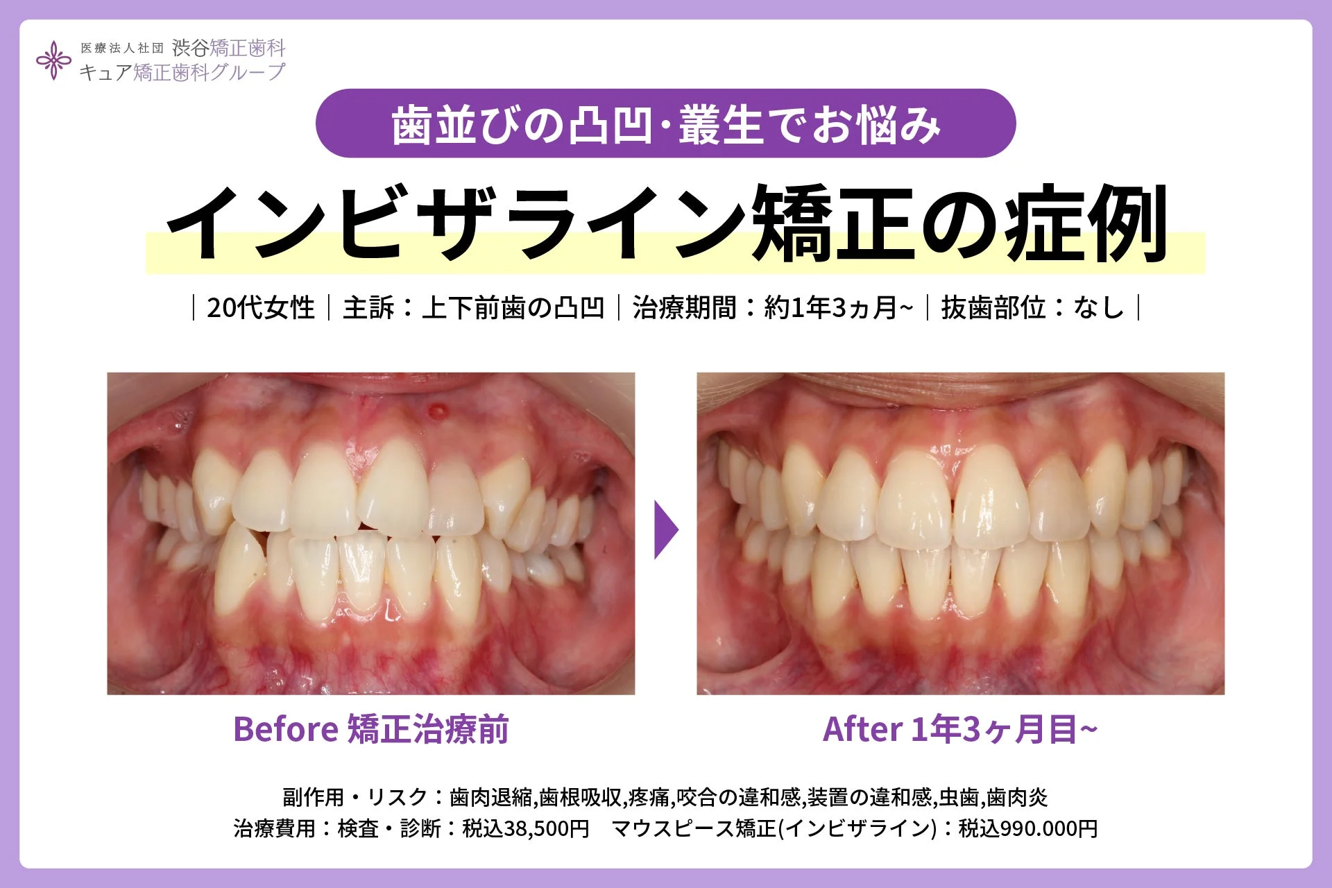 マウスピース矯正(インビザライン)による叢生治療の症例